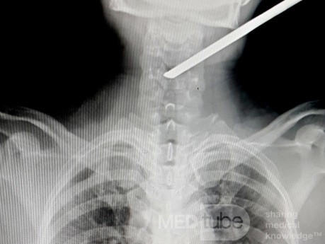 Spinal cord injury from spearfishing harpoon