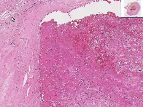 Thrombus, Atherosclerotic plaque - Histopathology of artery