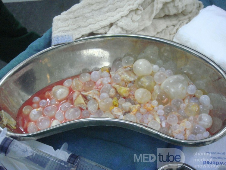 Liver hydatid cyst - daughter cysts