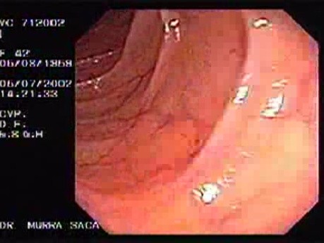 Crohn's Disease - Endoscopy (10 of 28)