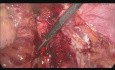Typical endometriosis of Douglas pouch. 