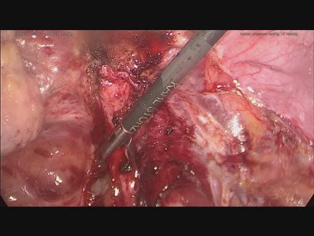 Typical endometriosis of Douglas pouch. 