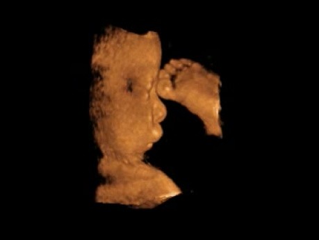 Cleft lip - 3D ultrasound picture