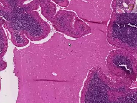 Papillary cystadenoma lymphoma - Histopathology of salivary gland