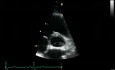 Parasternal View  At The Level Of The Aorta  Normal Study