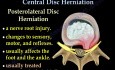 Central disc herniation - Video Lecture