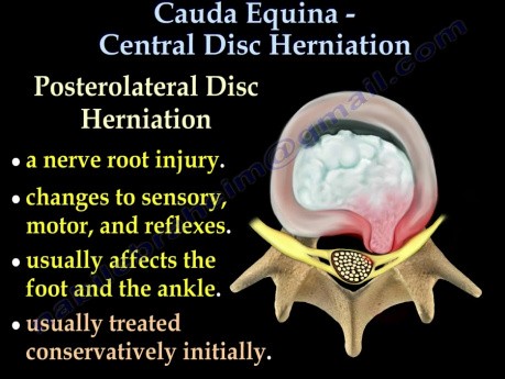 Central disc herniation - Video Lecture