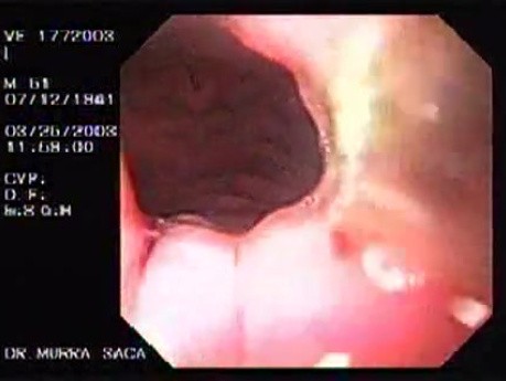 Banding of esophageal varices (12 of 17)