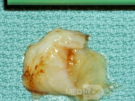 Maxillary Sinus Hypoplasia Type 2 [contents]