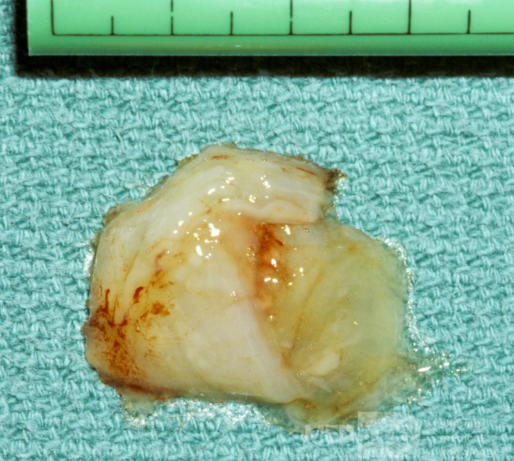 Maxillary Sinus Hypoplasia Type 2 [contents]