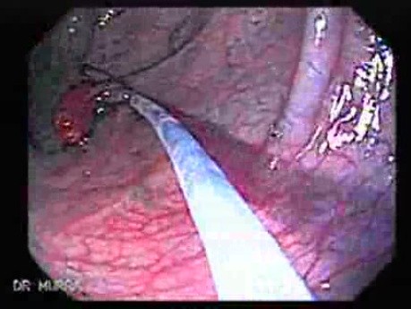 Juvenile Non Familial Polyposis of the Colon (34 of 37)