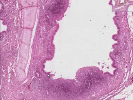 Bronchiectasis