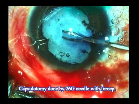 Traumatic Cataract Neglected