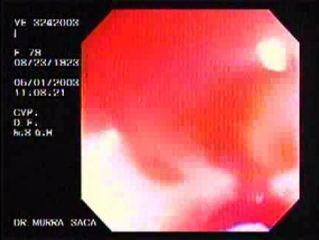 Dieulafoy´s Lesion (Exulceratio Simplex) (2 of 6)