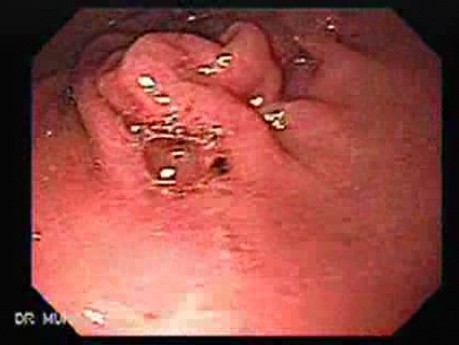 Intragastric Balloon For The Treatment Of Obesity