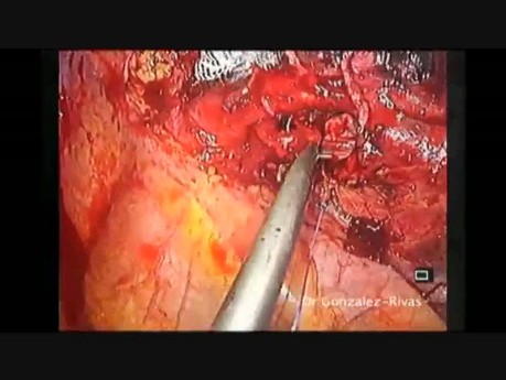 Sleeve Left Upper Lobectomy by Uniportal VATS
