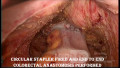 Laparoscopic Low Anterior Resection: step by step for low rectal cancer