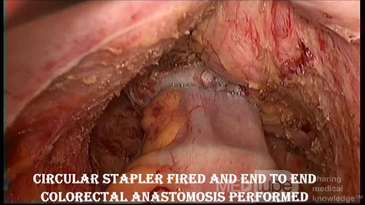 Laparoscopic Low Anterior Resection: step by step for low rectal cancer