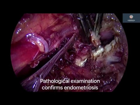 Deep Parametrium Endometriosis and Diffuse Peritoneal Disease - Posterior Compartment Peritonectomy