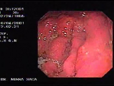 Hereditary Diffuse Gastric Cancer (HDGC) - Endoscopy (4 of 4)