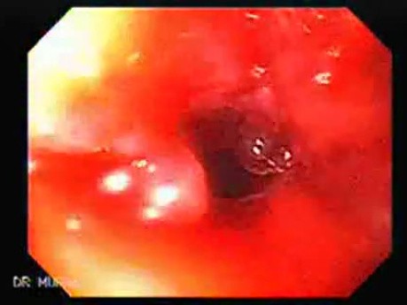 Perforation of a Esophageal Carcinoma after the procedure with hydrostatic balloon dilation (4 of 12)