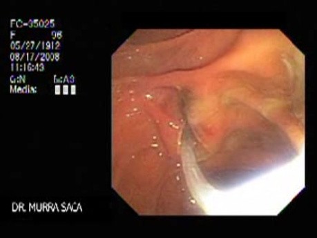 Acute Suppurative Cholangitis (4 of 8)