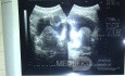 USG-hyperplasia prostate