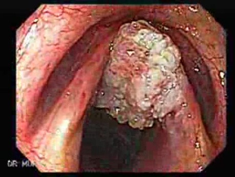 Adenocarcinoma of the Cardia and Carcinoma Epidermoid of the Larynx (2 of 26)