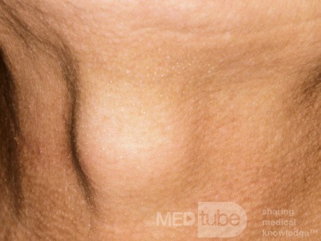 Thyroglossal Duct Cyst Before Swallowing