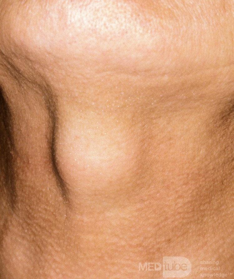Thyroglossal Duct Cyst Before Swallowing