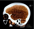 Acute Spontaneous Subdural Hemorrhage in the Subdural Space