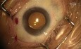 Removal of Retained Viscoelastic (OVD) Behind the Intraocular Lens (IOL)