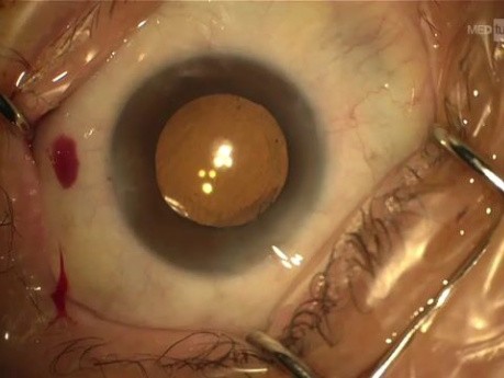 Removal of Retained Viscoelastic (OVD) Behind the Intraocular Lens (IOL)
