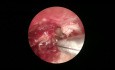 Cholesteatoma Surgery Endoscopic and Microscopic Approach
