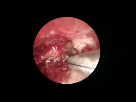 Cholesteatoma Surgery Endoscopic and Microscopic Approach