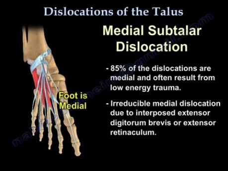 Dislocations Of The Talus 