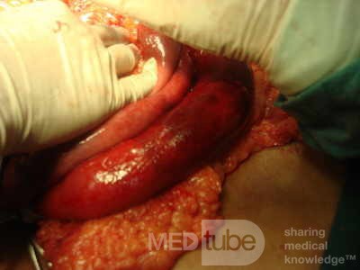 Mesenteric Ischemia (7 of 12)