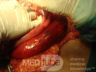 Mesenteric Ischemia (7 of 12)