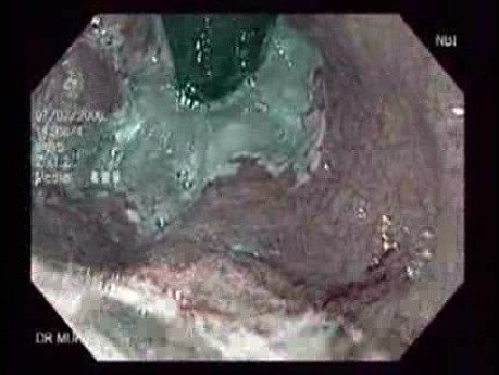 Adenocarcinoma of Cardia with Signet Ring Cells (4 of 6)