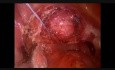 Suture Suspension for Prolapse 