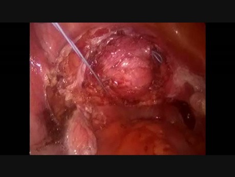 Suture Suspension for Prolapse 
