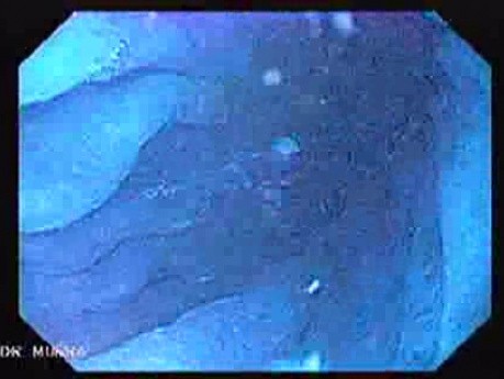 Gastric Folds - Chromoendoscopy (5 of 8)