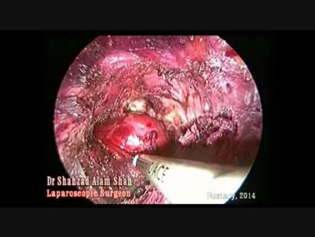 Endoscopic Trans Axial Thyroidectomy: ETAT