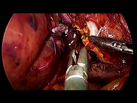 Laparoscopic Right Hemihepatectomy Caudal Approach Without Pringle Maneuver