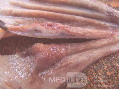 Early Gastric Cancer (12 of 21)