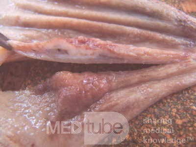 Early Gastric Cancer (12 of 21)