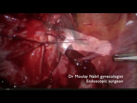 Challenging 12cm Myomectomy