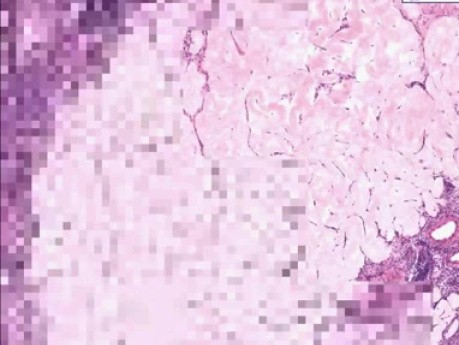 Squamous cell carcinoma