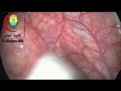 Identification of The Ureter