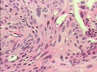 Perforation of a Esophageal Carcinoma after the procedure
 with hydrostatic balloon dilation (12 of 12)